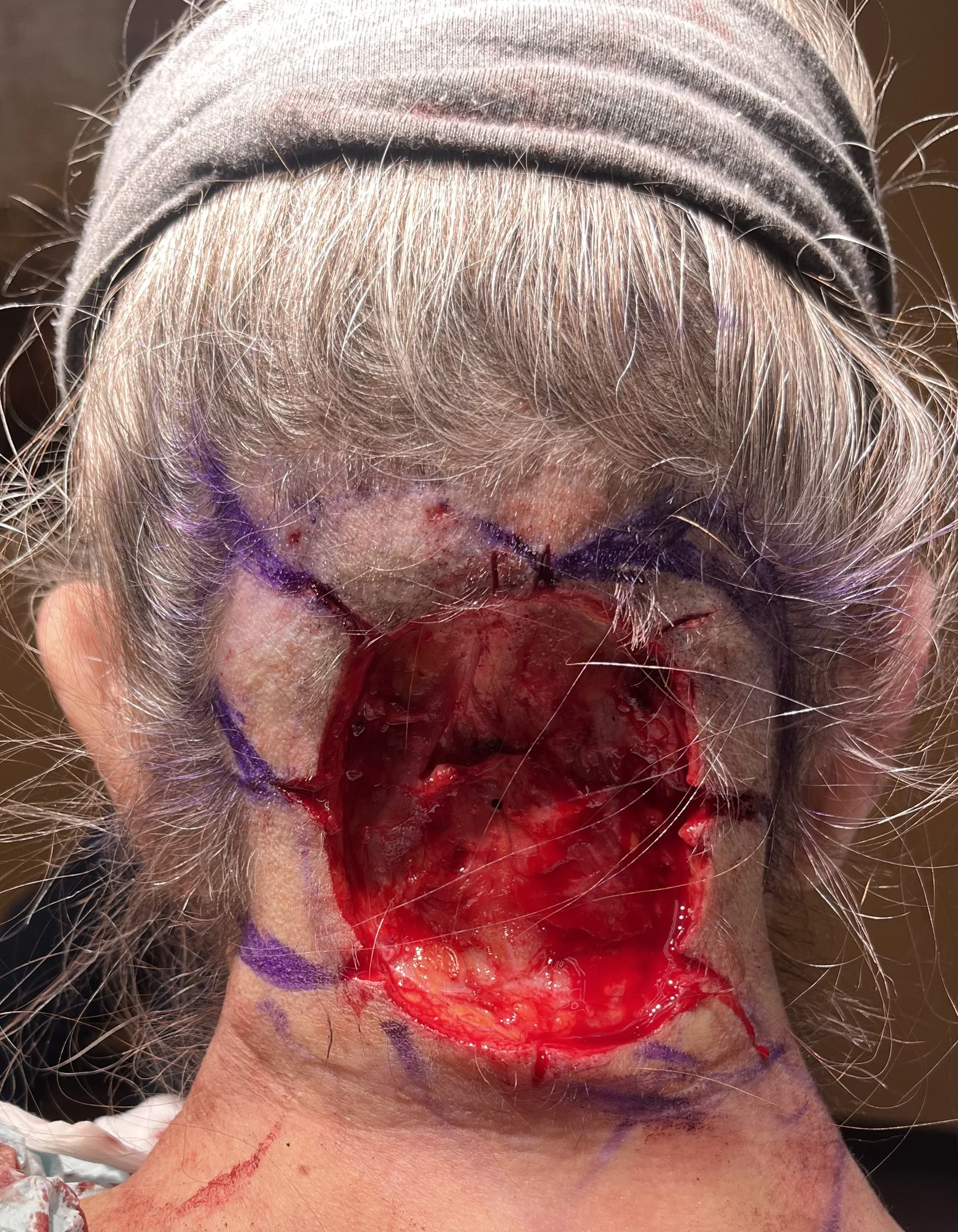 Before Mohs reconstruction
