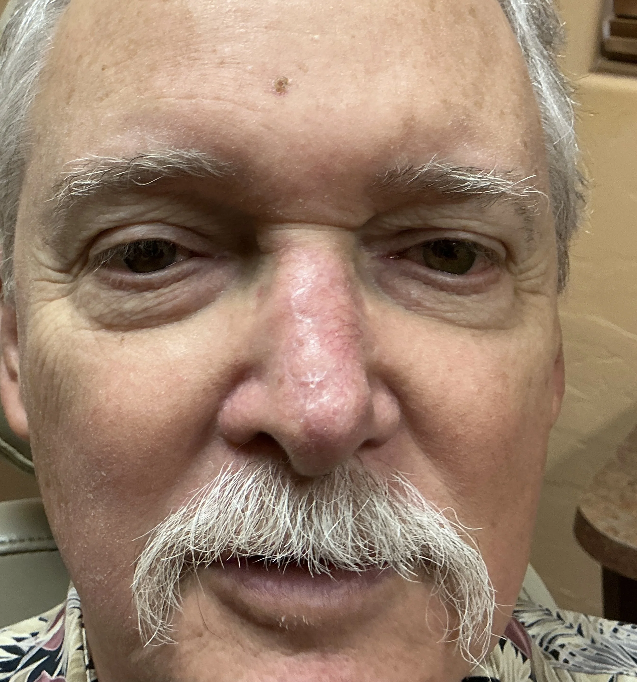 After Mohs reconstruction