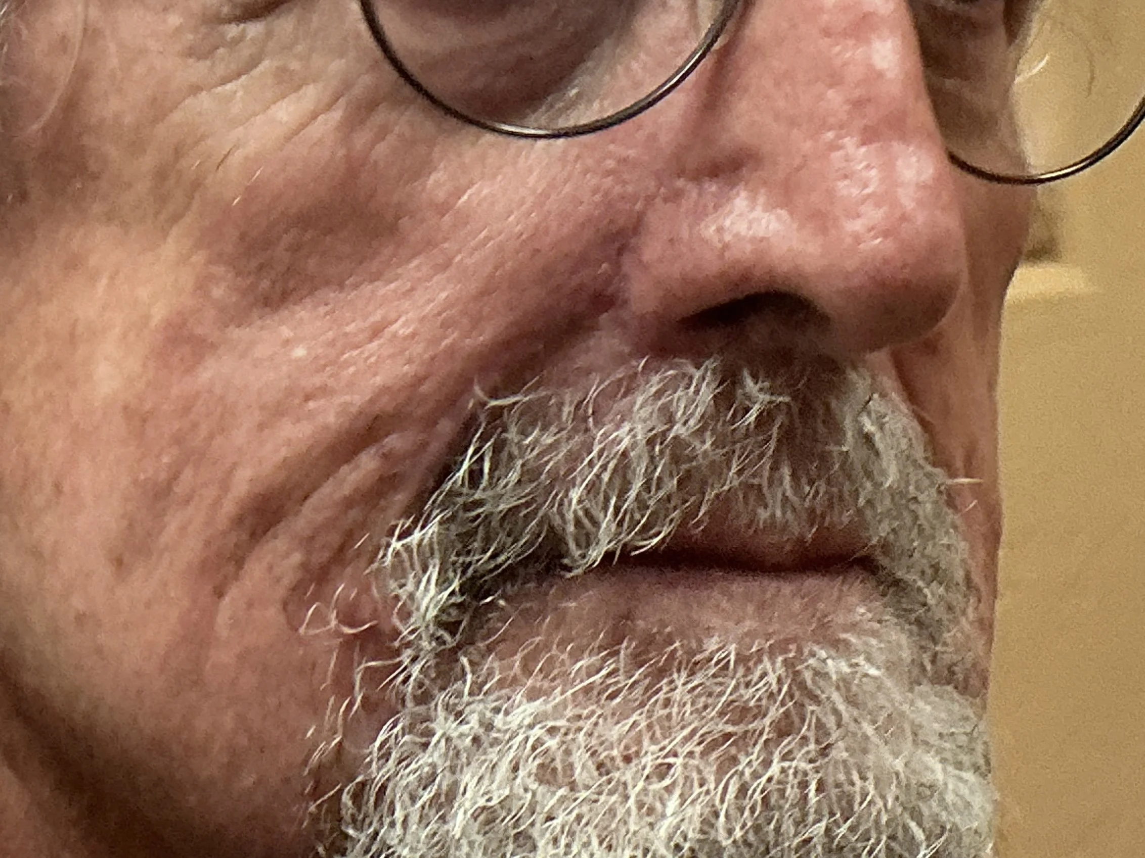 After Mohs reconstruction