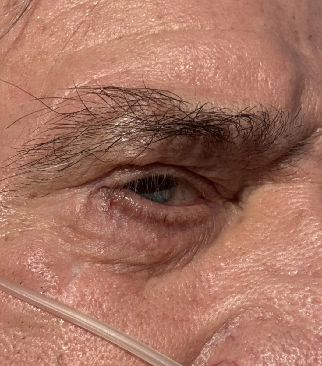 After Mohs reconstruction