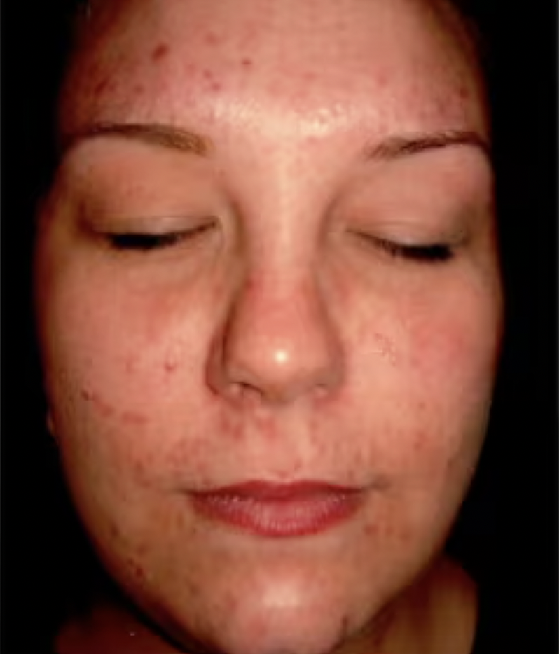 Before treating adult acne