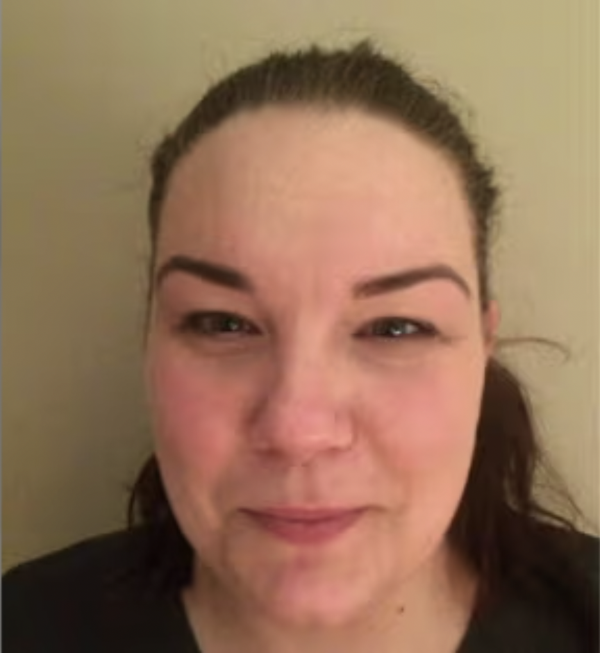 After treating adult acne