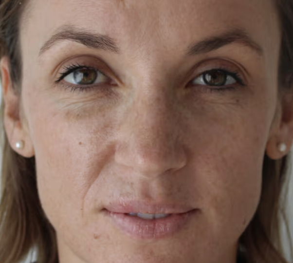 After treating pigmentation