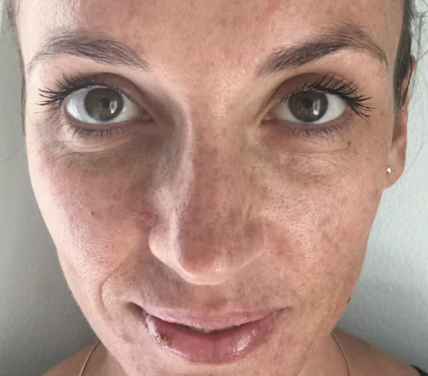 Before treating pigmentation