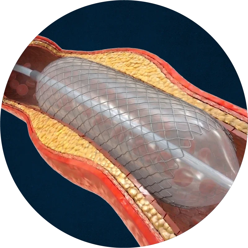 Balloon angioplasty opening the artery