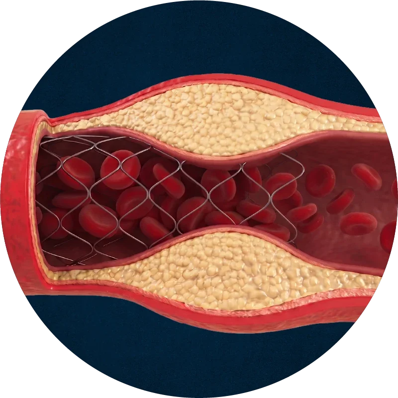 Artery narrowed again through restenosis
