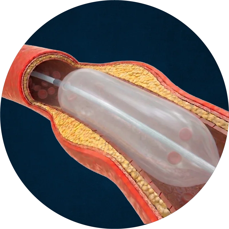Balloon angioplasty opening the artery