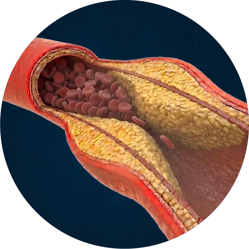 Artery narrowed by plaque buildup