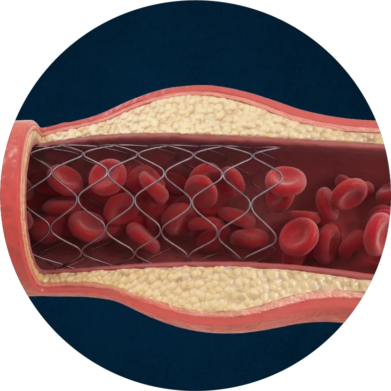 Blood flow restored following angioplasty