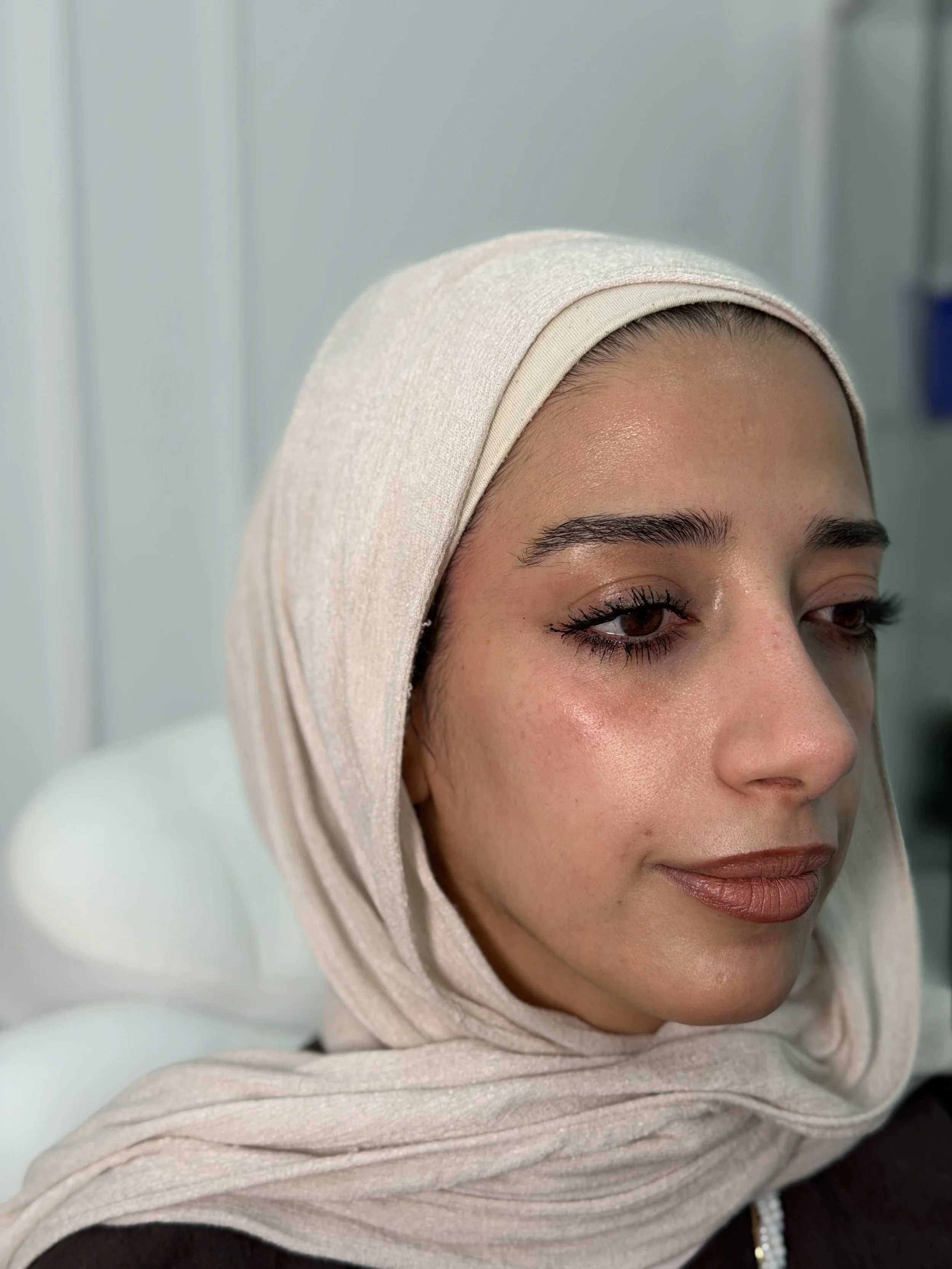 قبل — فيلر الخدين
