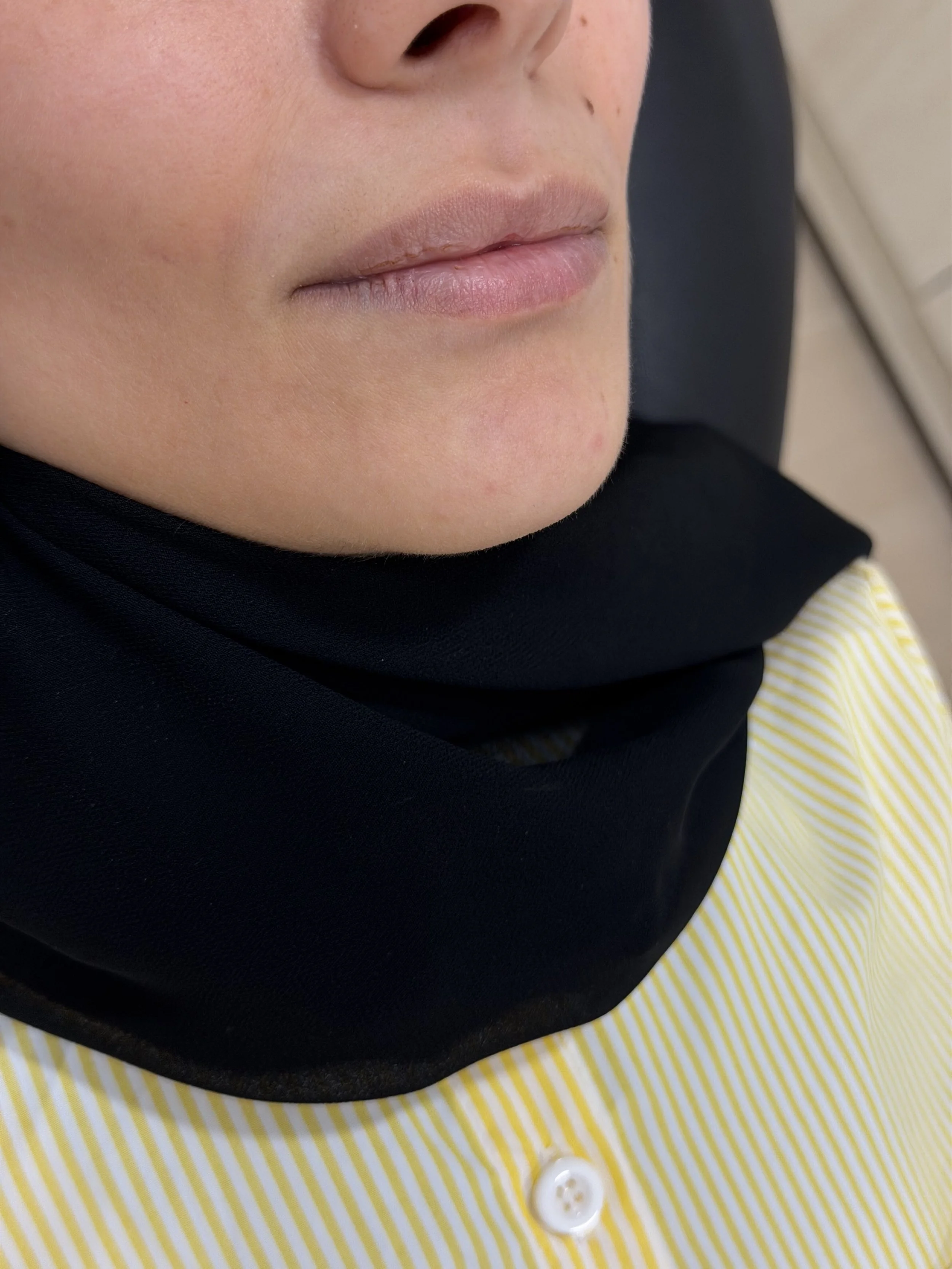 قبل — فيلر الشفاه