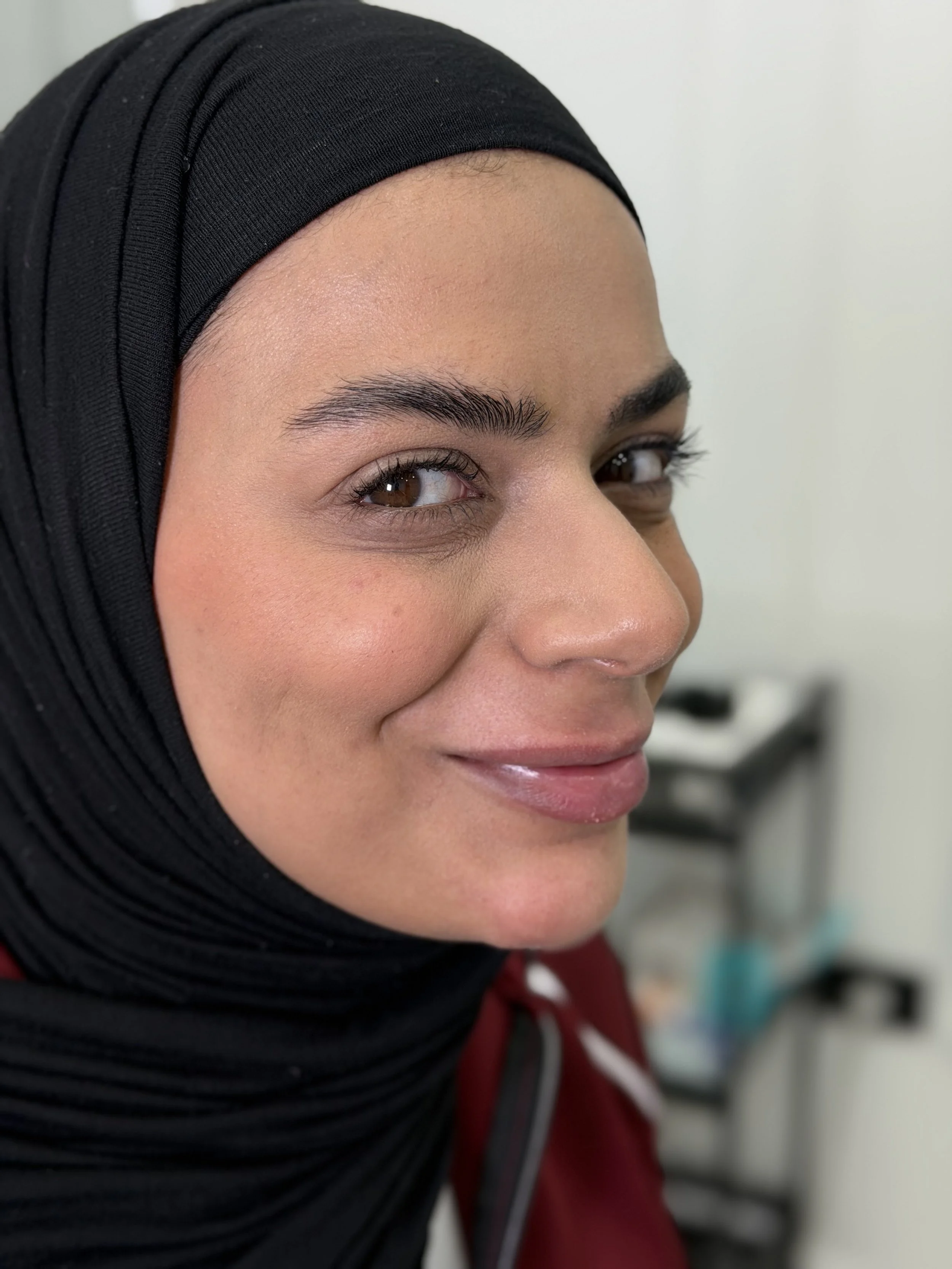 بعد — حقن مضادة للتجاعيد