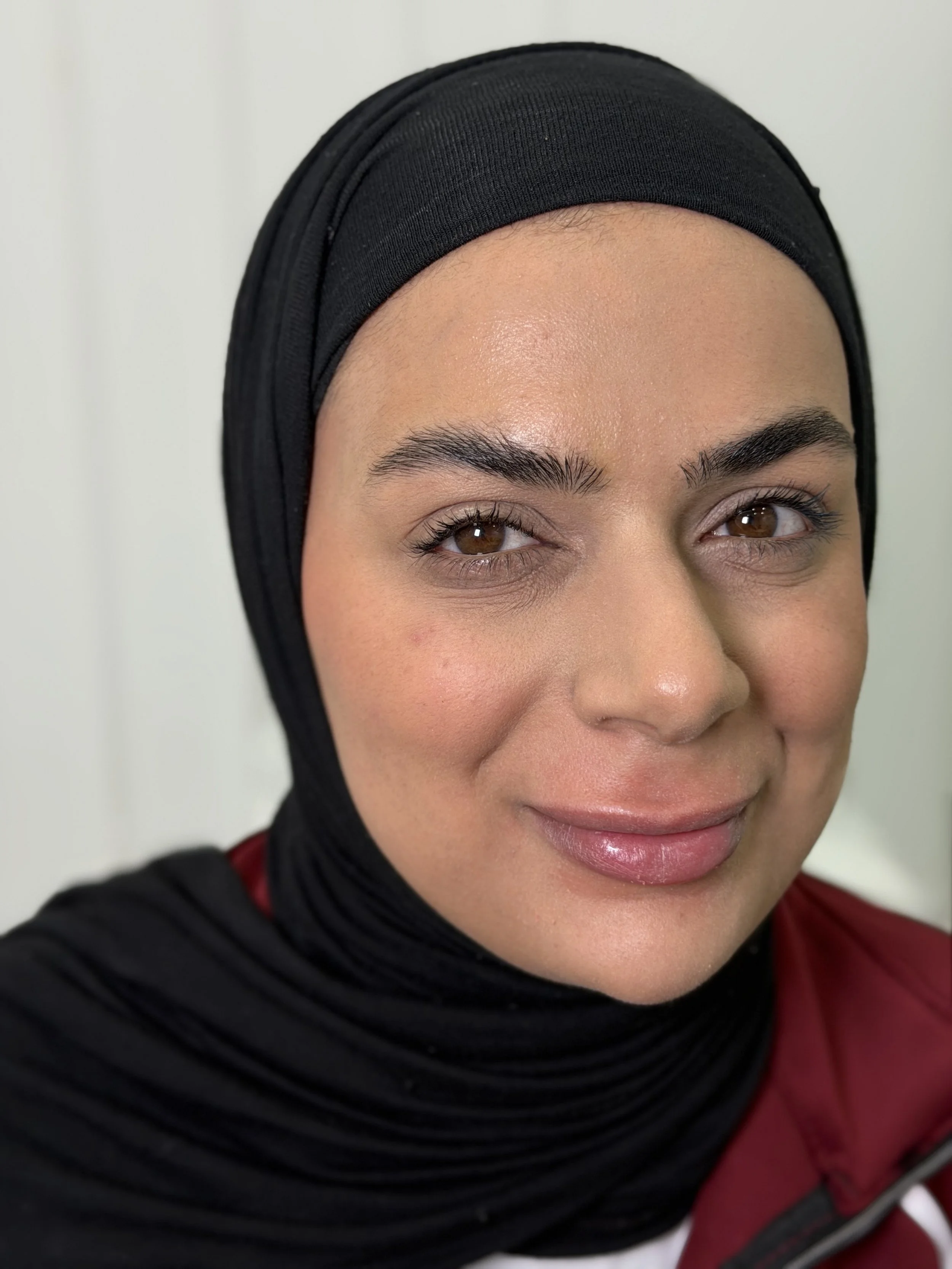 بعد — حقن مضادة للتجاعيد