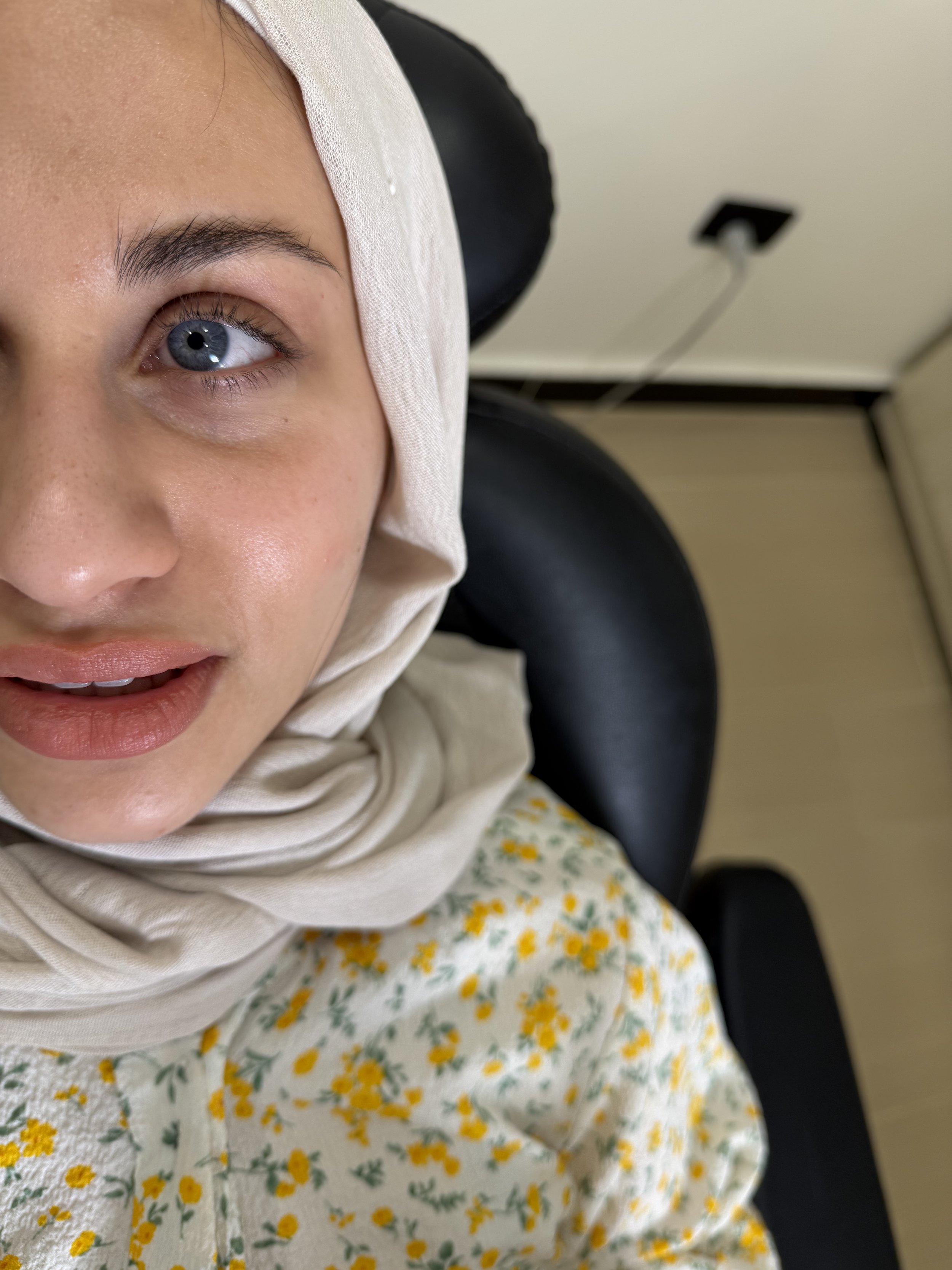 قبل — فيلر تحت العين