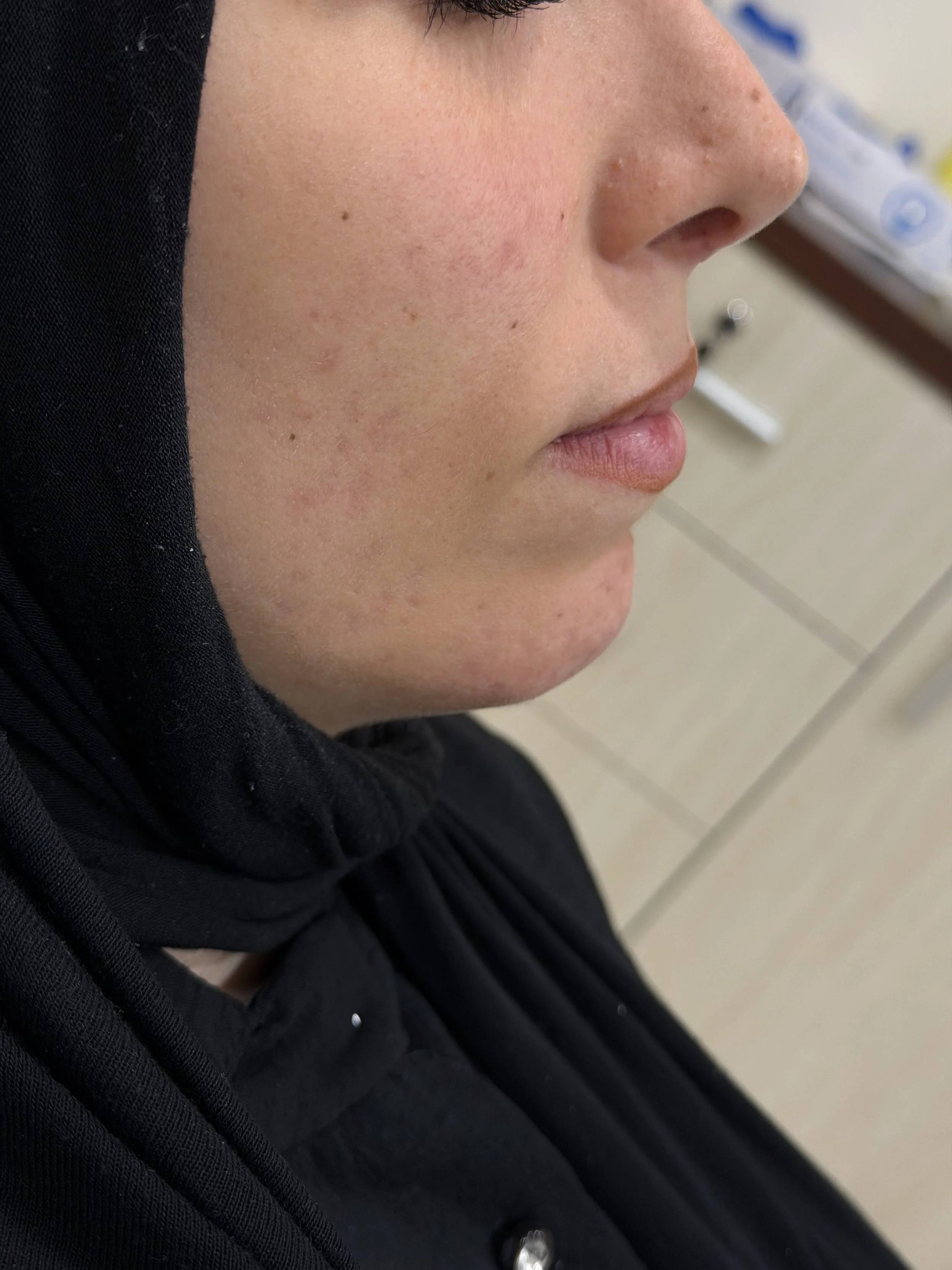 قبل — فيلر الذقن والفك