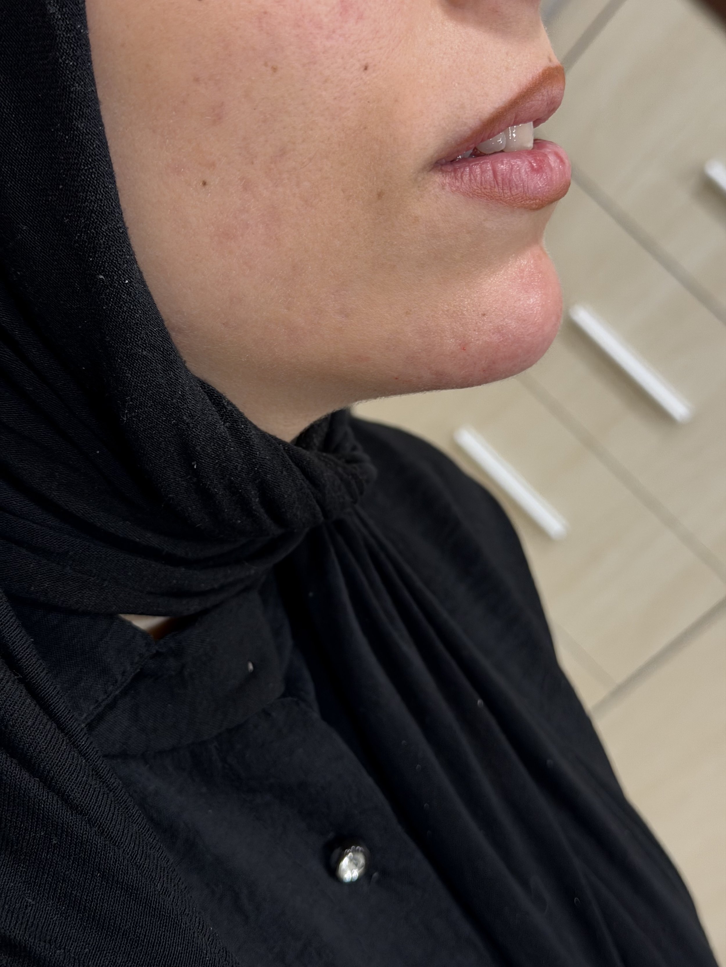 بعد — فيلر الذقن والفك