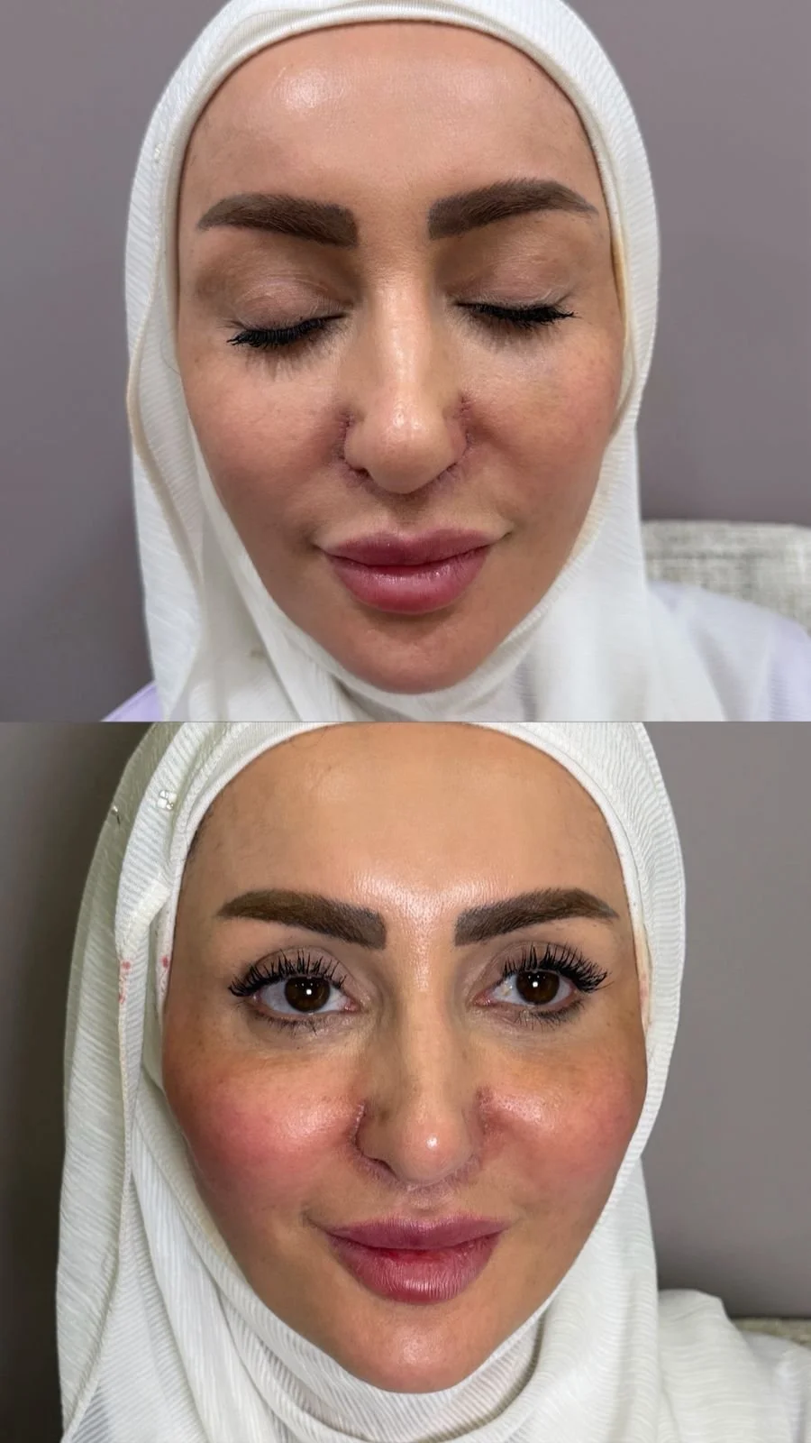 قبل وبعد — Dubai Injection، الوجه بالكامل