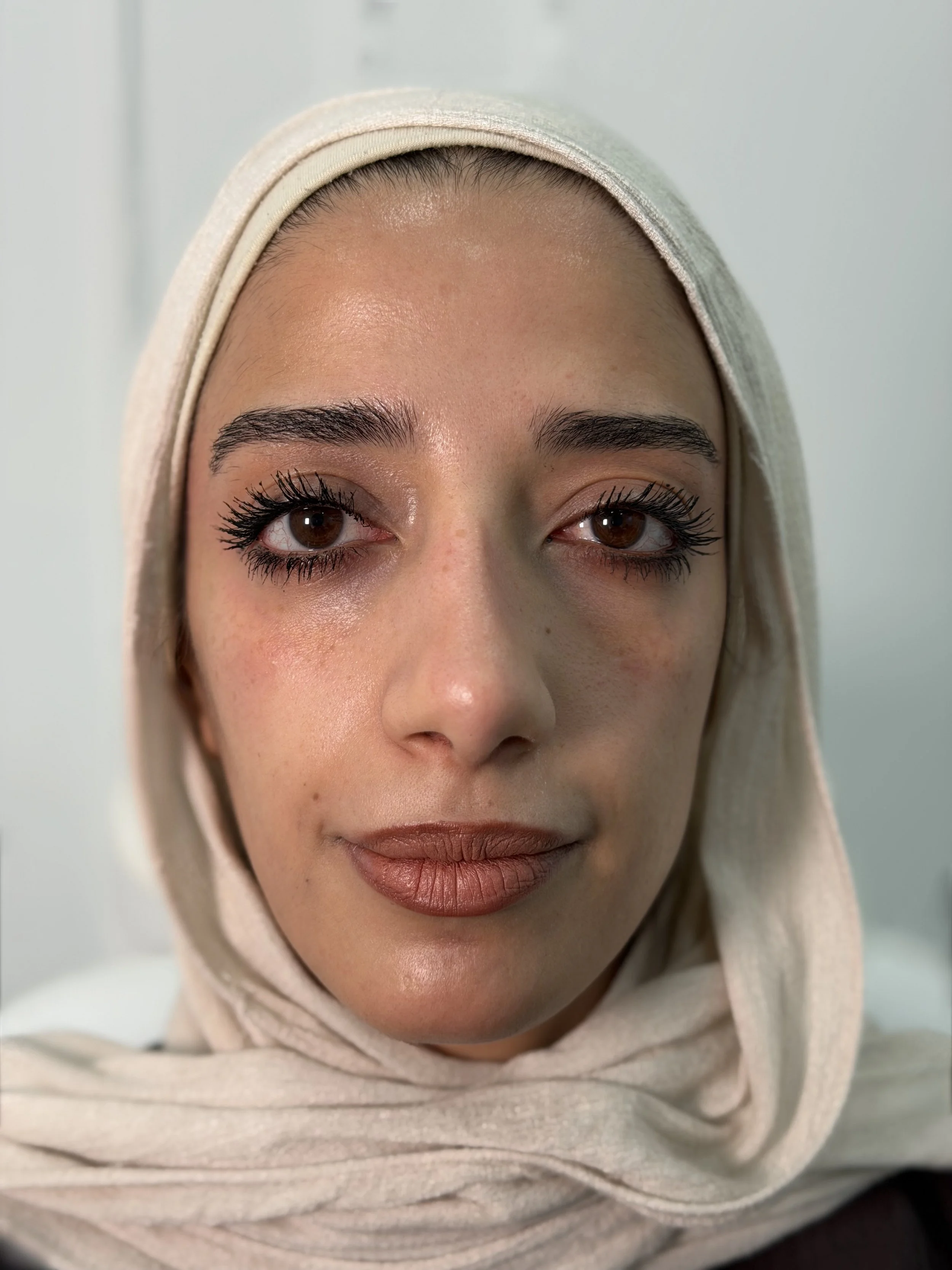 قبل — فيلر الخدين