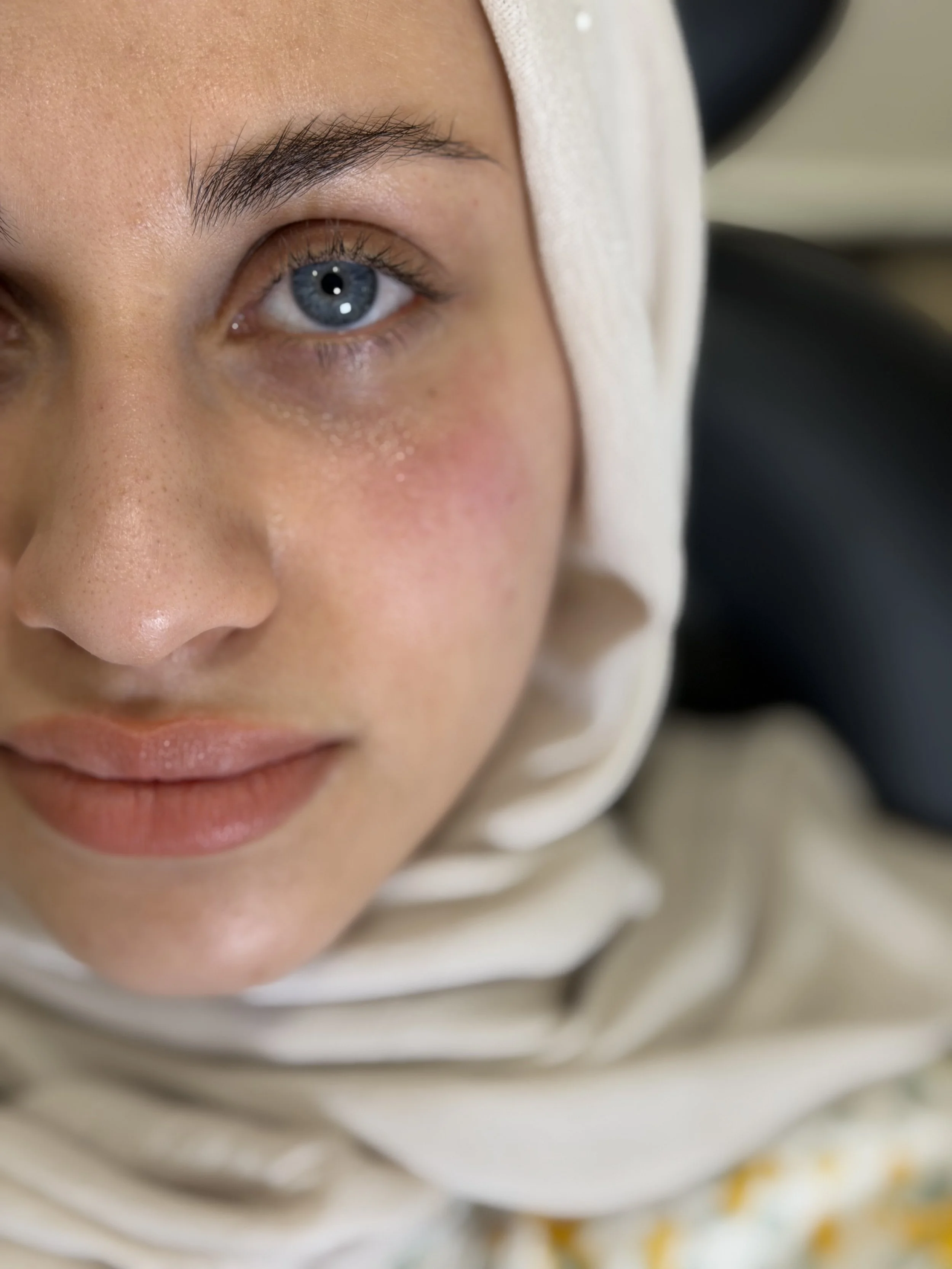 بعد — فيلر تحت العين