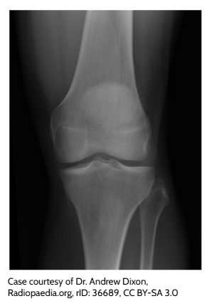 Knee X-ray showing internal bone structures for medical image analysis