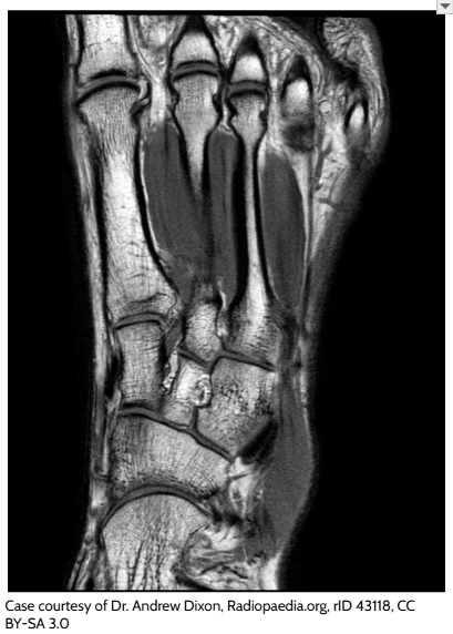 Foot MRI used to examine soft tissues that are difficult to see in an X-ray