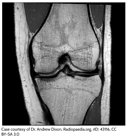Knee MRI showing soft-tissue detail in a cross-sectional medical image