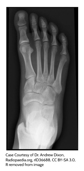 Foot X-ray used to compare what different medical imaging methods reveal
