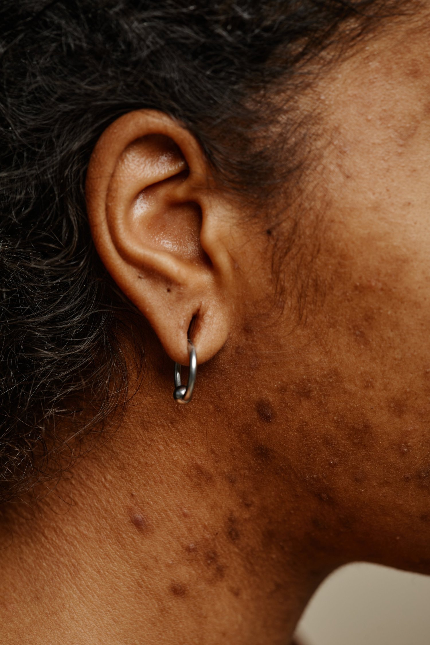 Why dark spots appear after summer