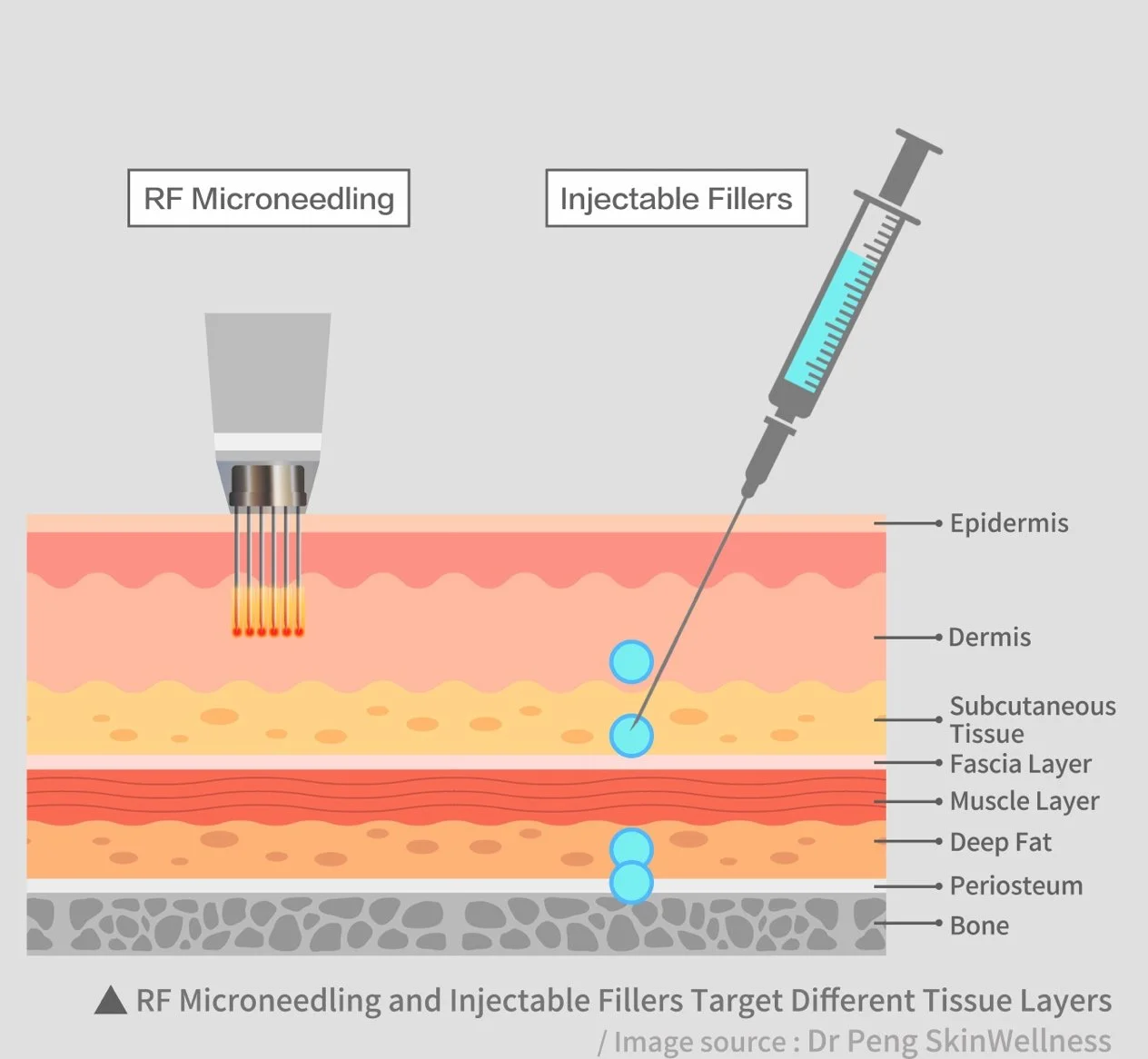RF microneedling and injectable filler treatment depths