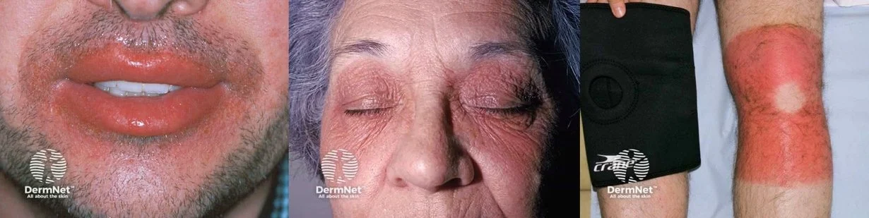 Allergic contact dermatitis after exposure to mango peel