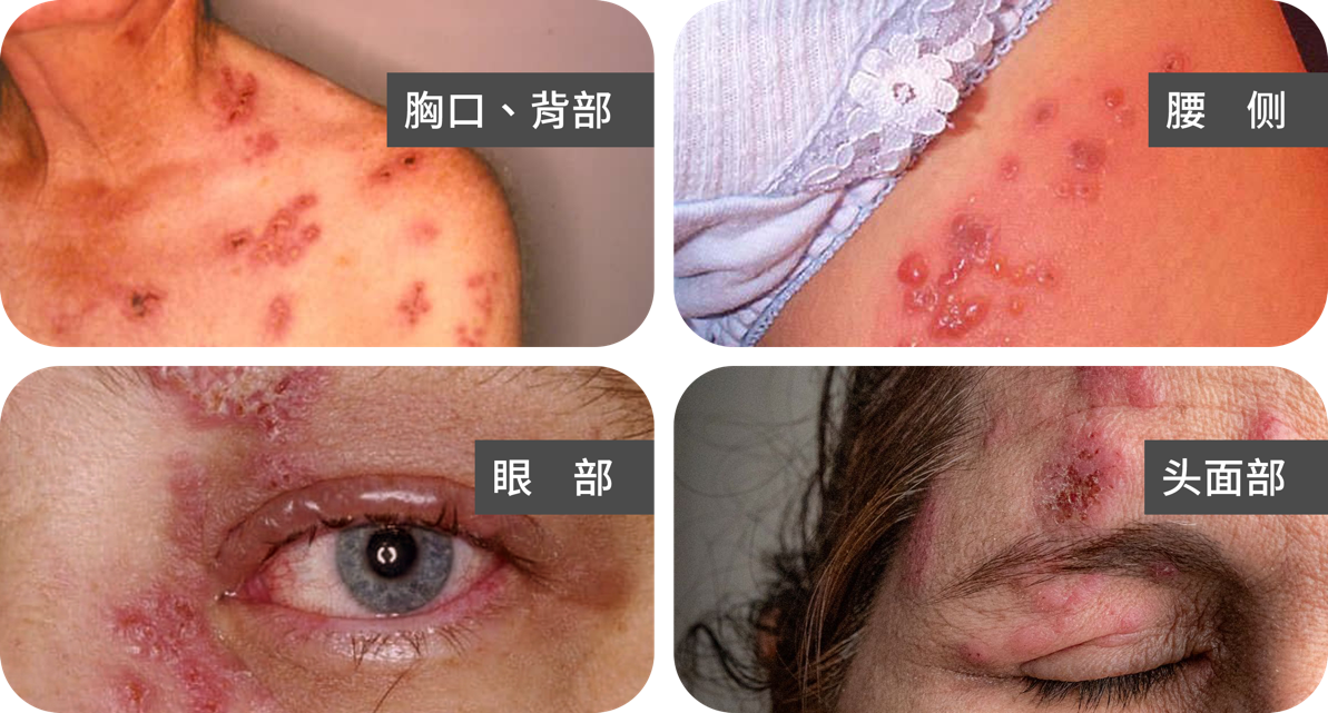 带状疱疹典型皮疹表现