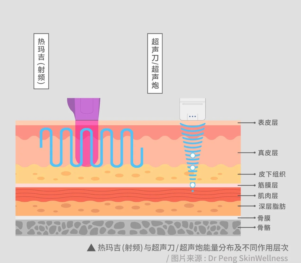 射频与超声能量作用层次示意图