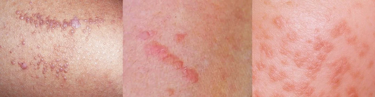 扁平疣的外观特点