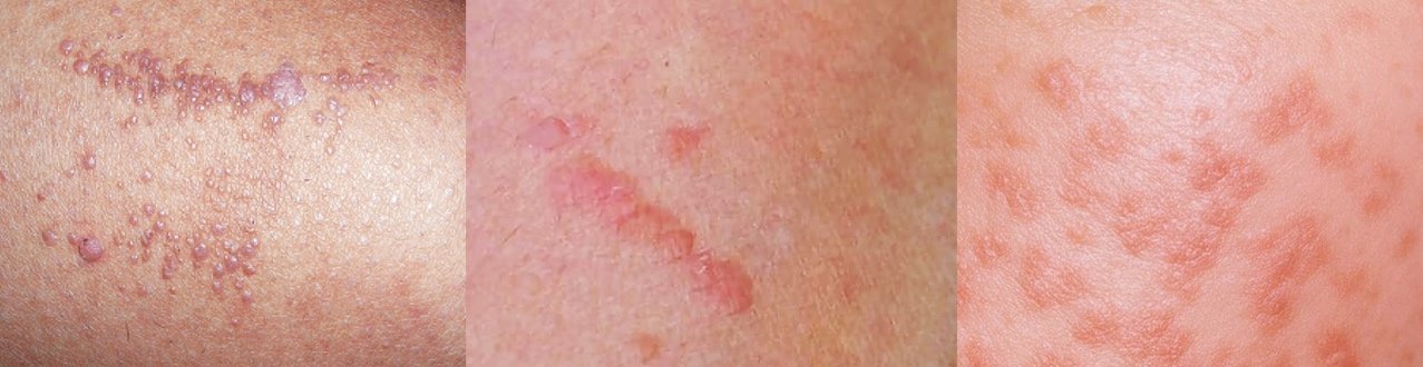 Examples of flat warts on the skin