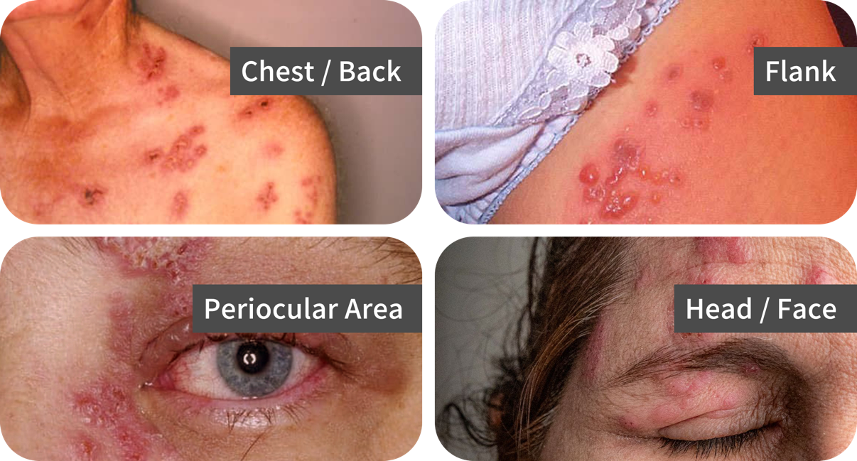 Examples of a shingles rash