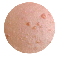 Flat warts (Verruca plana)