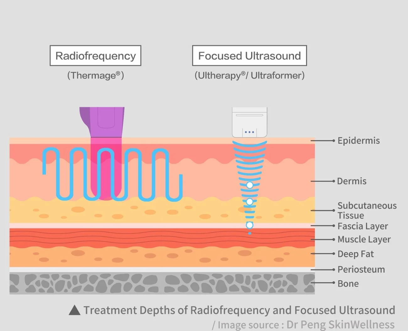 Radiofrequency and ultrasound treatment depths