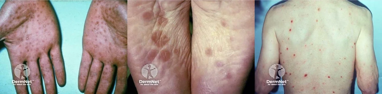 Secondary syphilis: rash including palms and soles