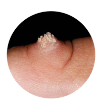 Common warts (Verruca vulgaris)