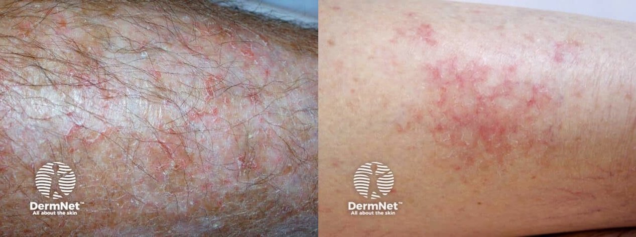 Asteatotic eczema showing dry, cracked and inflamed skin