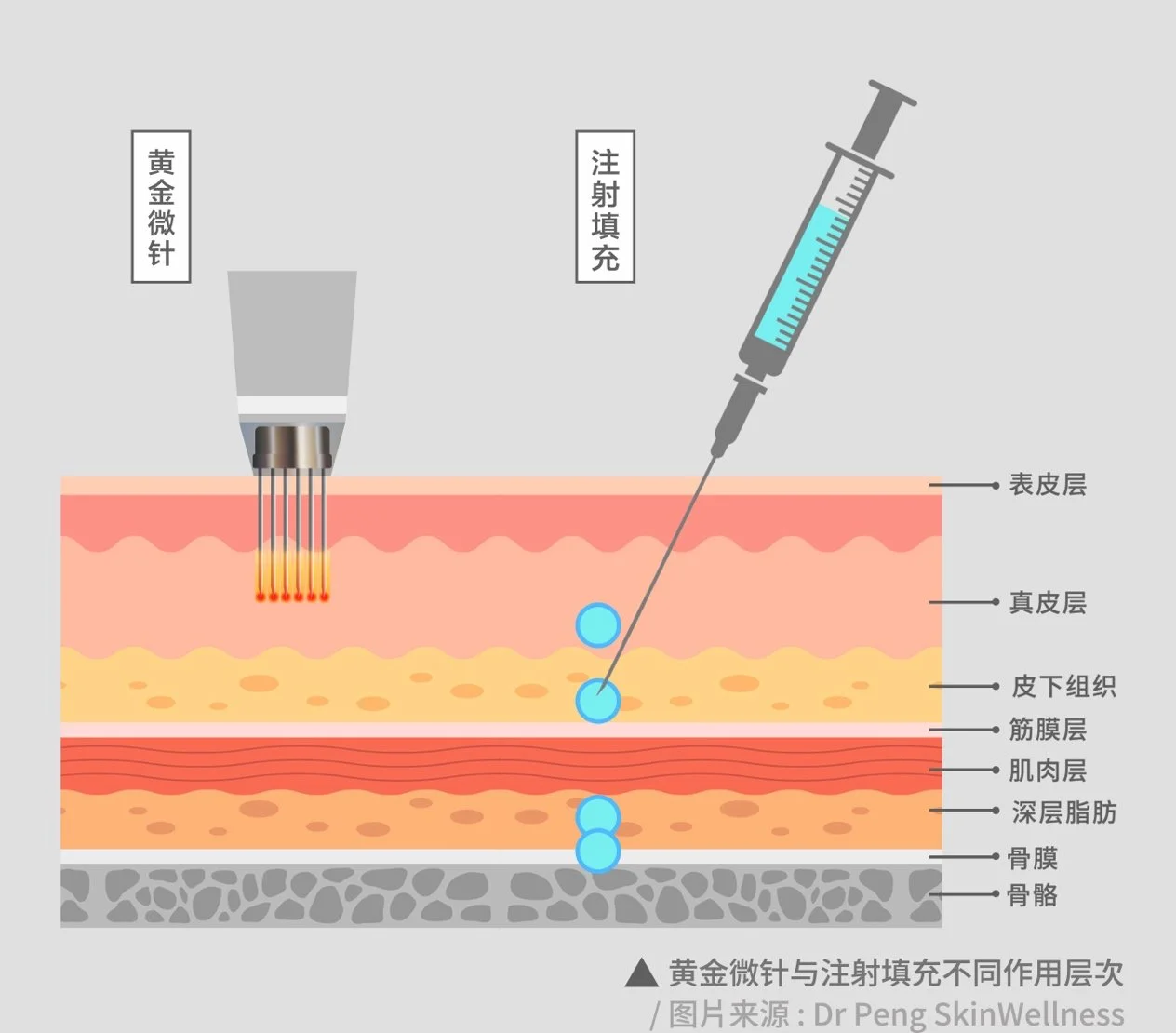 黄金微针与注射填充作用层次示意图