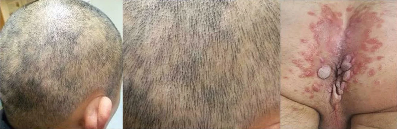 Moth-eaten alopecia and condyloma lata