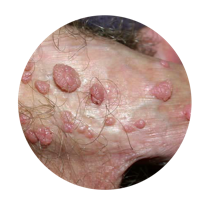 Genital warts (Condyloma acuminata)