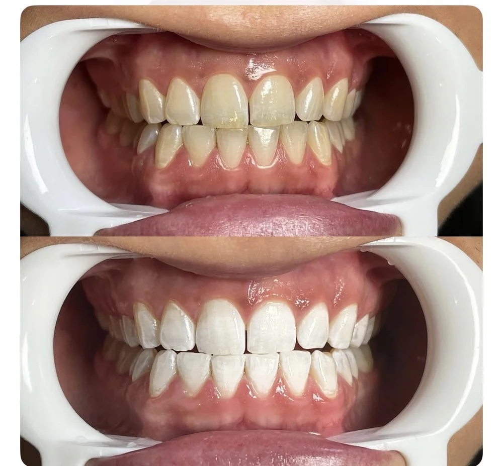 Before and after professional teeth whitening, real client result
