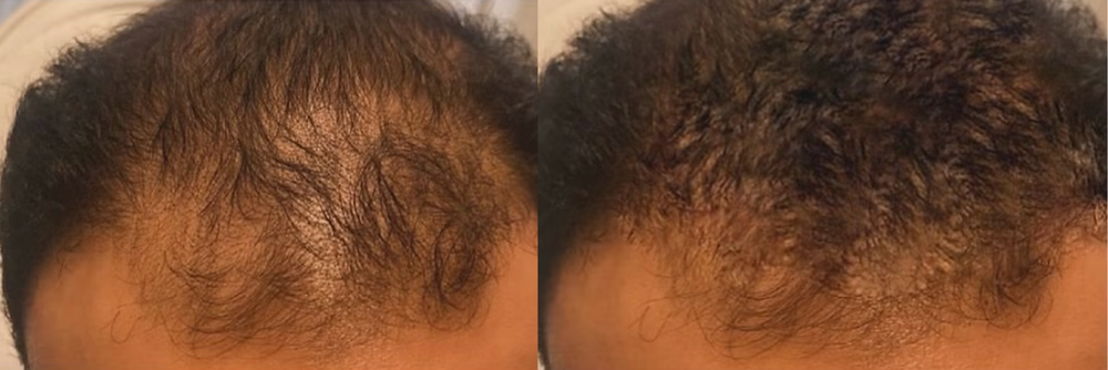 Before and after PRP hair restoration, real client result