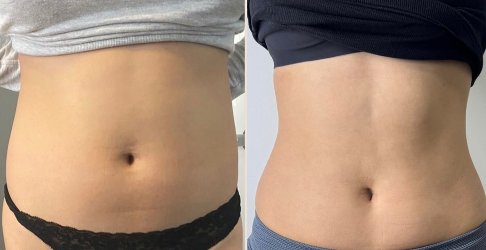 Before and after CoolSculpting of the abdomen, Nutrl Reserve client