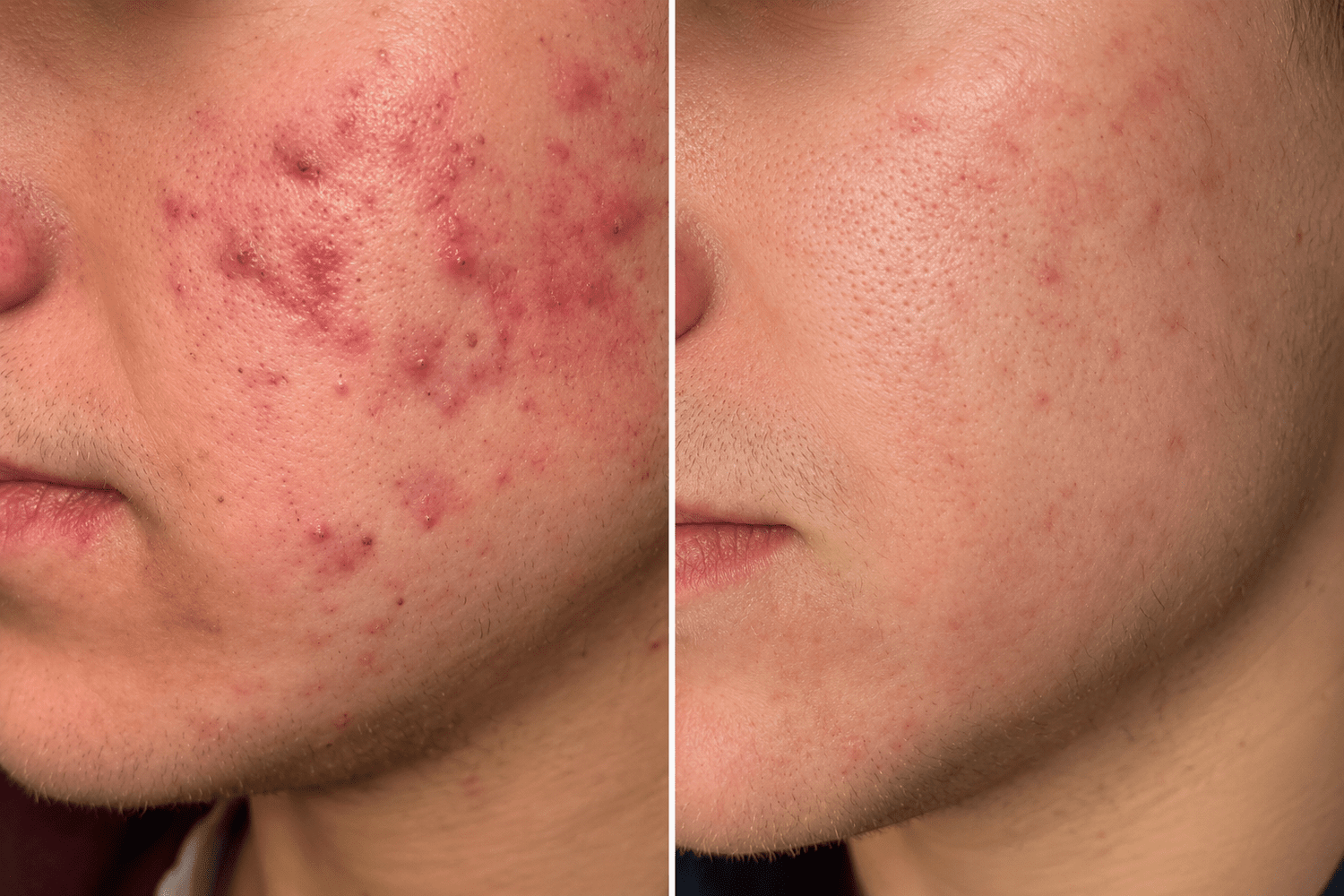 Before and after Morpheus8 treatment, real client result