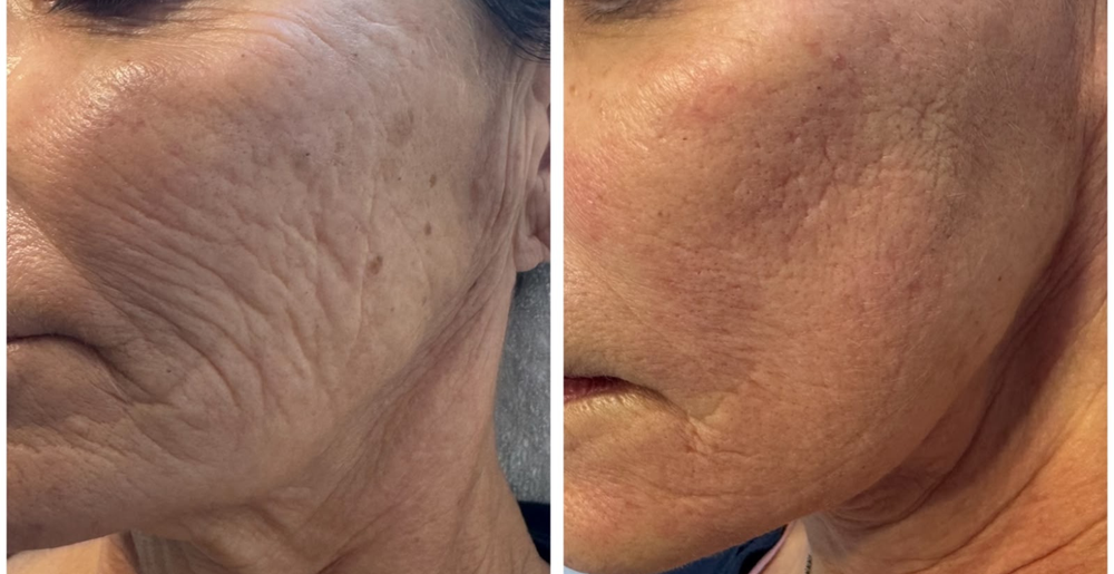 Before and after Thermage, real client result