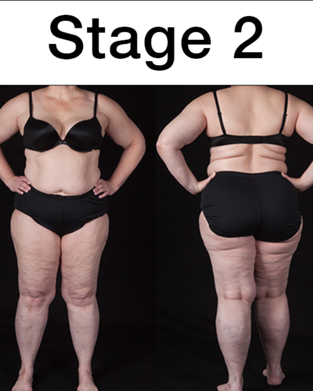 Illustration of Lipedema stage 2