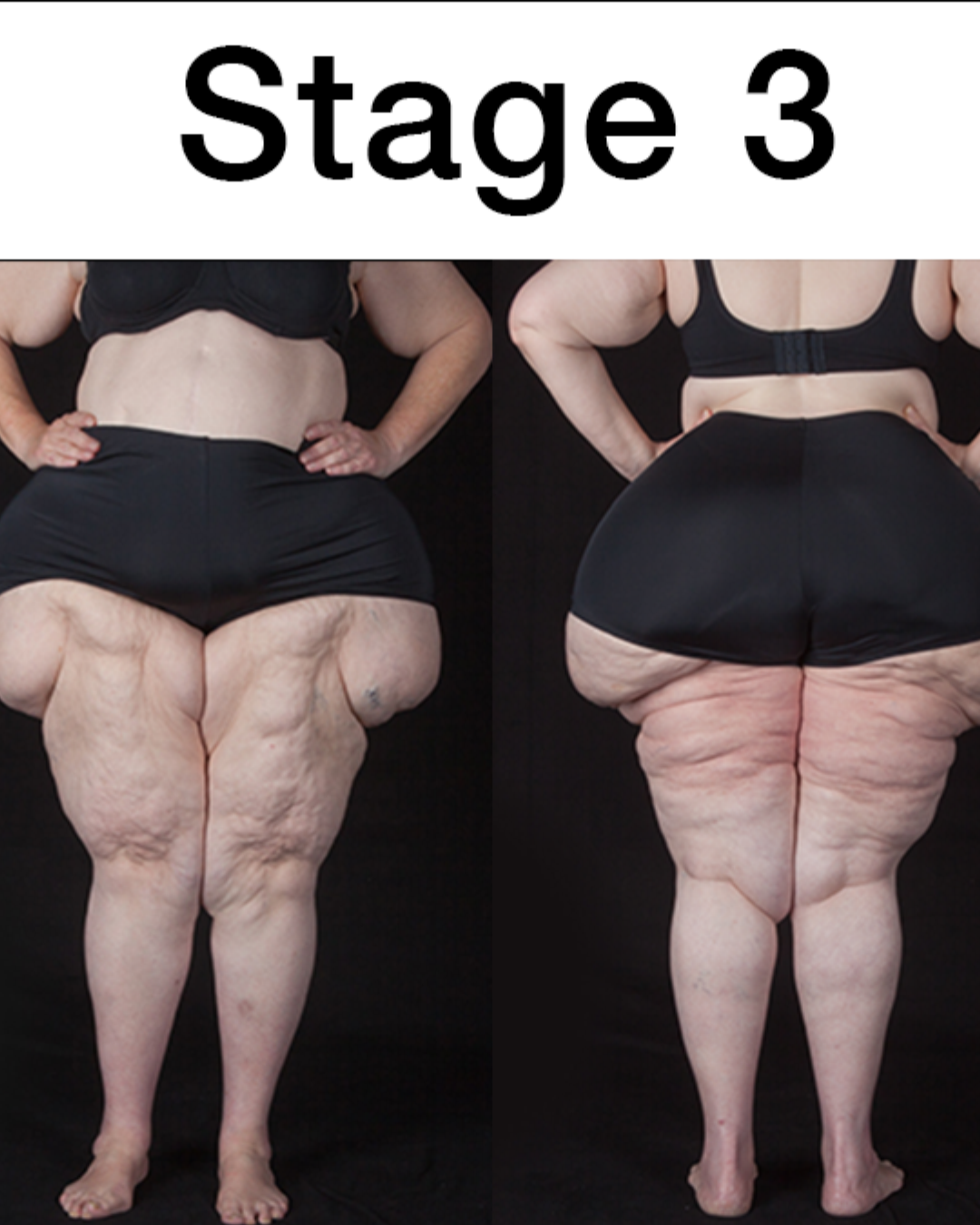 Illustration of Lipedema stage 3